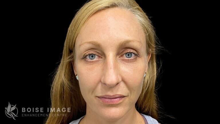 Dr. Morgann Eason Facial Balancing Result