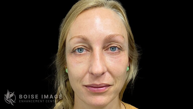Dr. Morgann Eason Facial Balancing Before