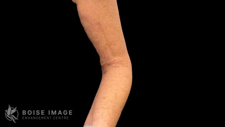 Dr. Morgann Eason Body Skin Tightening Result
