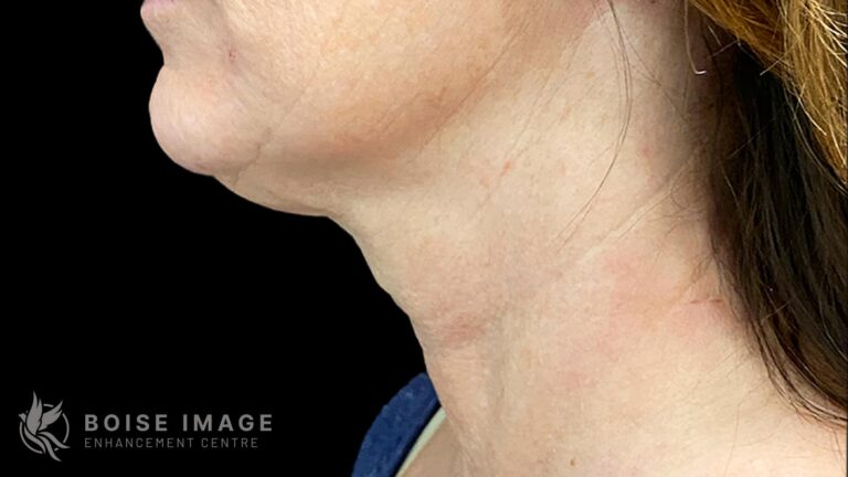 Dr Morgann Eason Ultherapy Neck Result