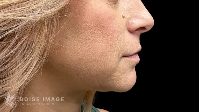 Dr. Morgann Eason CoolSculpting Double Chin Result